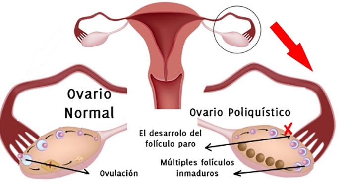 Sintomas del ovario poliquistico